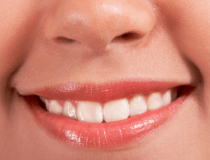 Veneers Yorba Linda